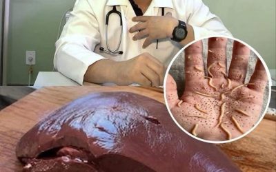 Läkare avslöjar att ätande av nötlever kan
