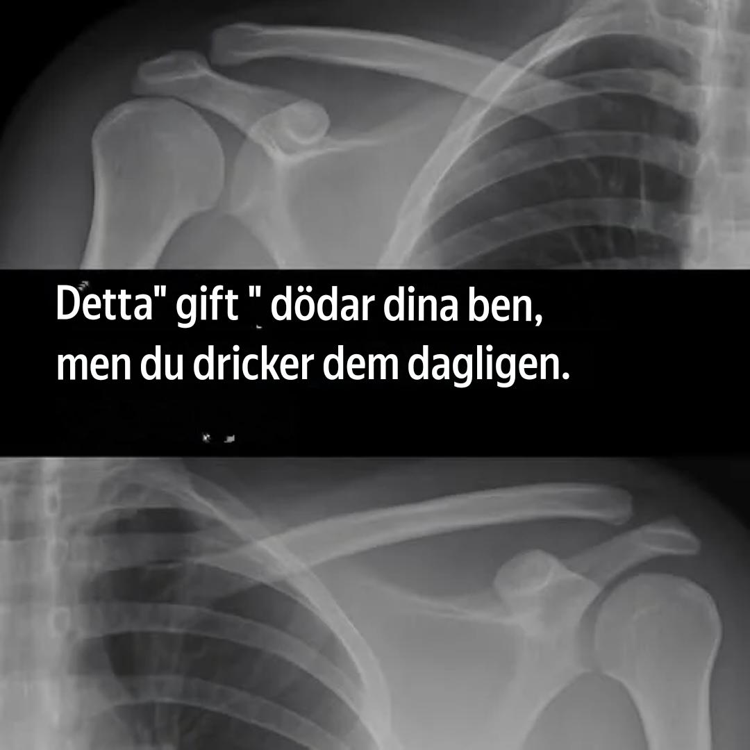 Detta ”gift” skadar dina ben – och du dricker det varje dag!