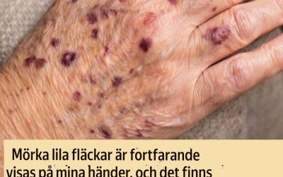 Mörklila fläckar dyker upp regelbundet på mina händer, och mitt läkarbesök är några veckor bort. Vad ska jag göra under tiden? (Facebook-länk)