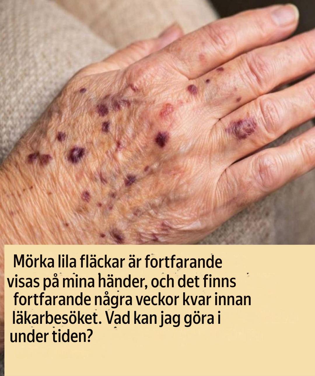 Mörklila fläckar dyker upp regelbundet på mina händer, och mitt läkarbesök är några veckor bort. Vad ska jag göra under tiden? (Facebook-länk)