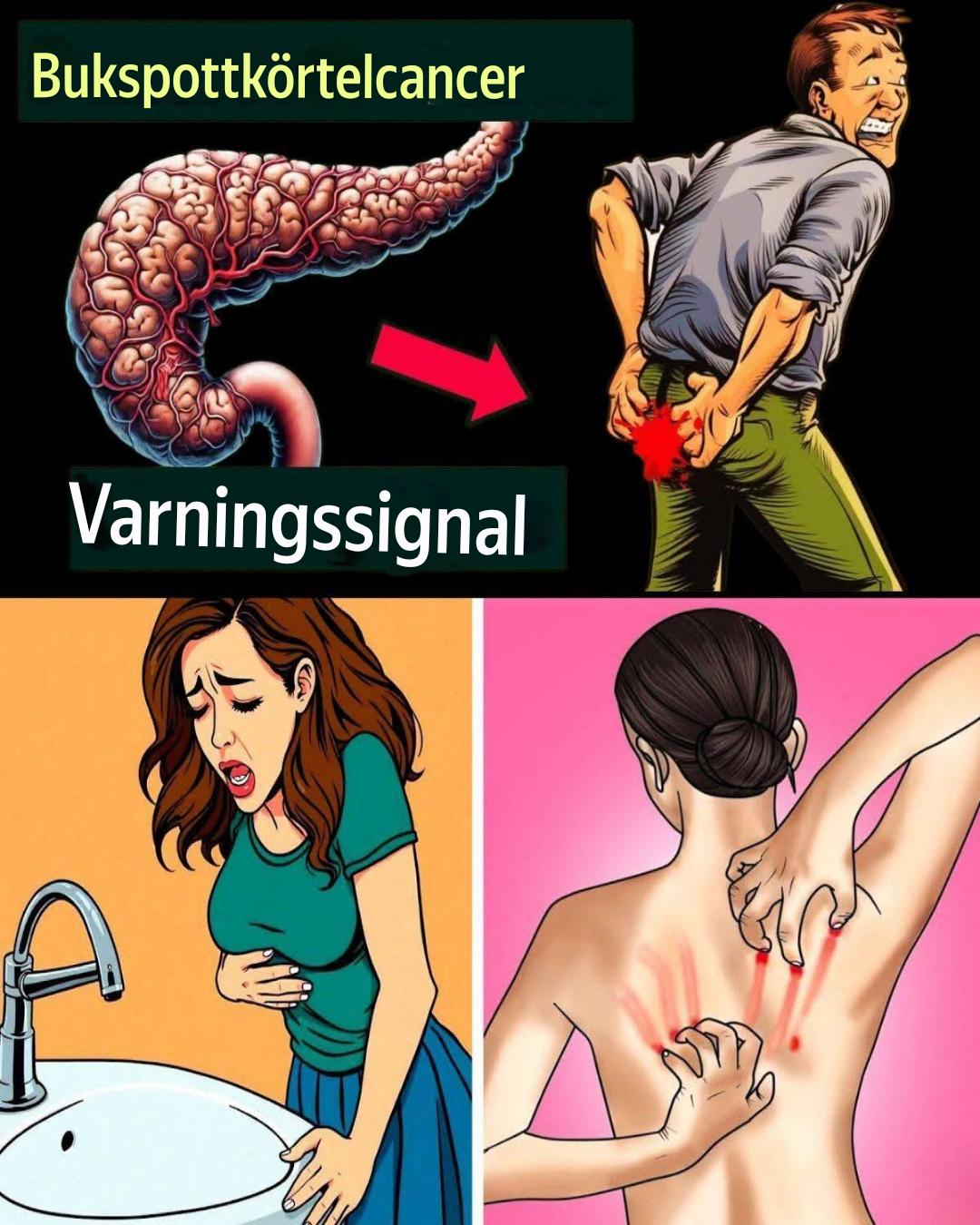 10 chockerande varningstecken på bukspottkörtelcancer som du inte kan ignorera
