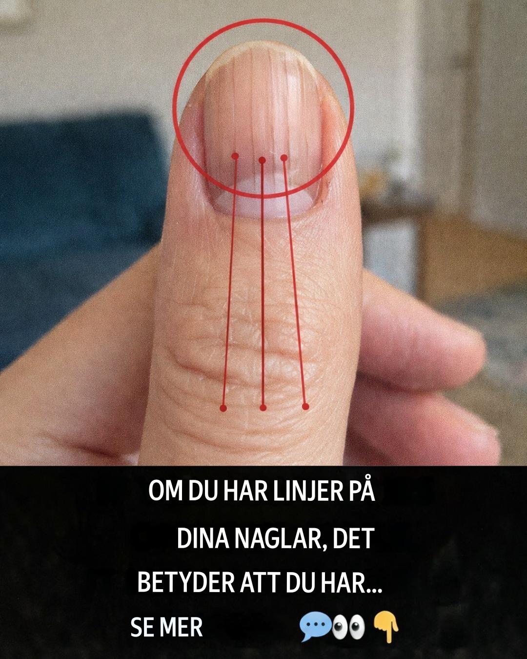 Nagellinjer: Vad de kan avslöja om din hälsa